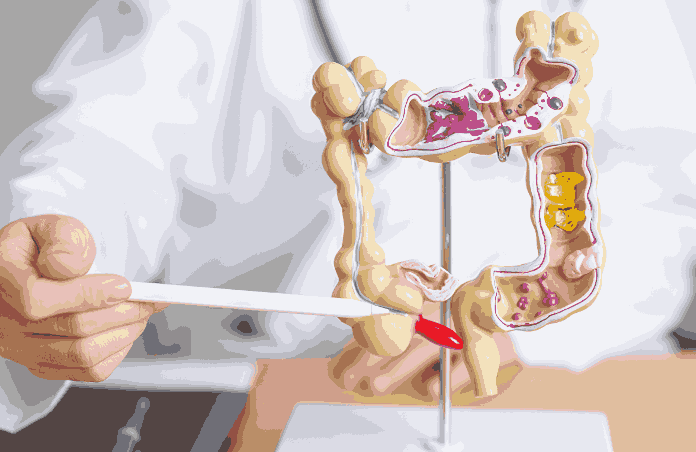 Understanding and Managing Ulcerative Colitis: A Comprehensive Guide